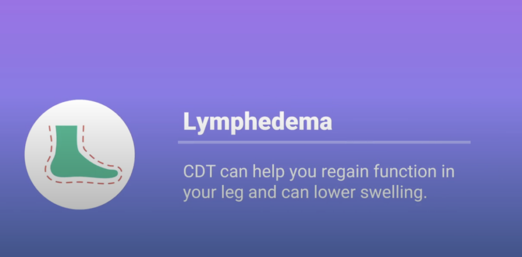 Lymphedema CDT Technique